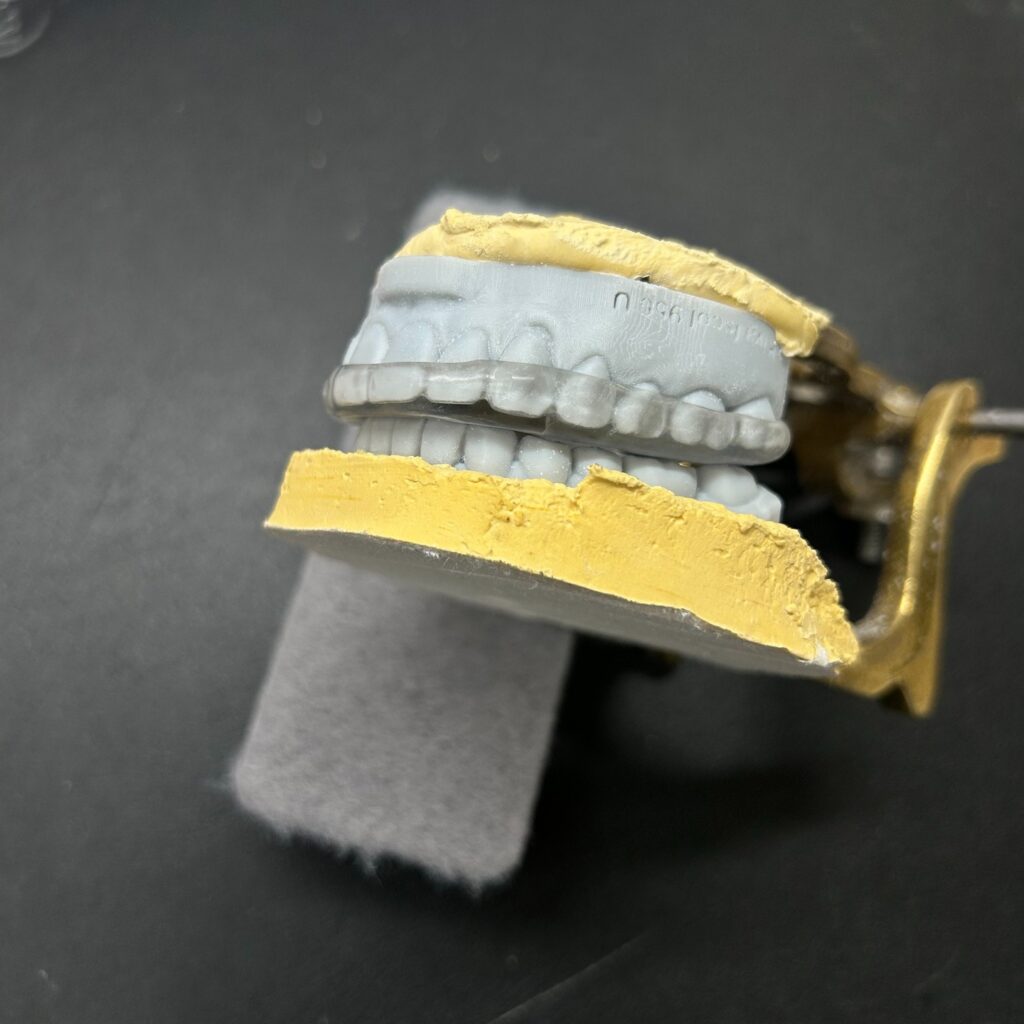 Inman Digital Splint model photo